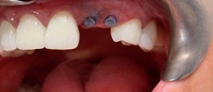 Close-up of a dog’s mouth with missing teeth and dark dental spots