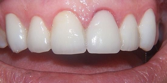 Close-up of smiling mouth showing white upper teeth and pink lips