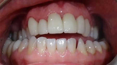 Close-up of a smiling mouth showing upper and lower teeth with pink gums