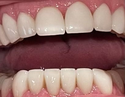 Close-up of an open mouth showing white teeth and pink gums, with a tongue visible.