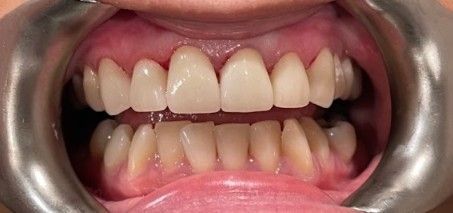 Close-up of an open mouth showing upper and lower teeth, with a silver dental retractor