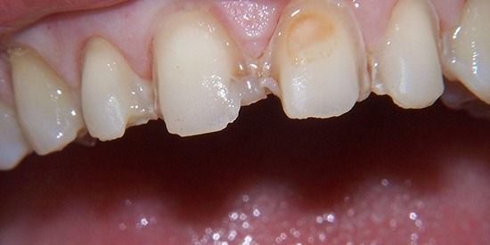 Close-up of upper front teeth with a chipped central tooth and visible gum line