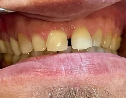 Close-up of upper front teeth with a noticeable gap between the two center teeth.