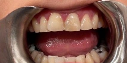 Open mouth showing teeth and tongue, with a visible metal dental retractor