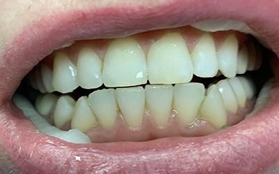 Close-up of an open mouth showing teeth and gums, with lips slightly parted.