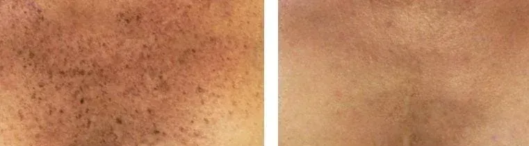 A before and after picture of a person 's hair on their legs.