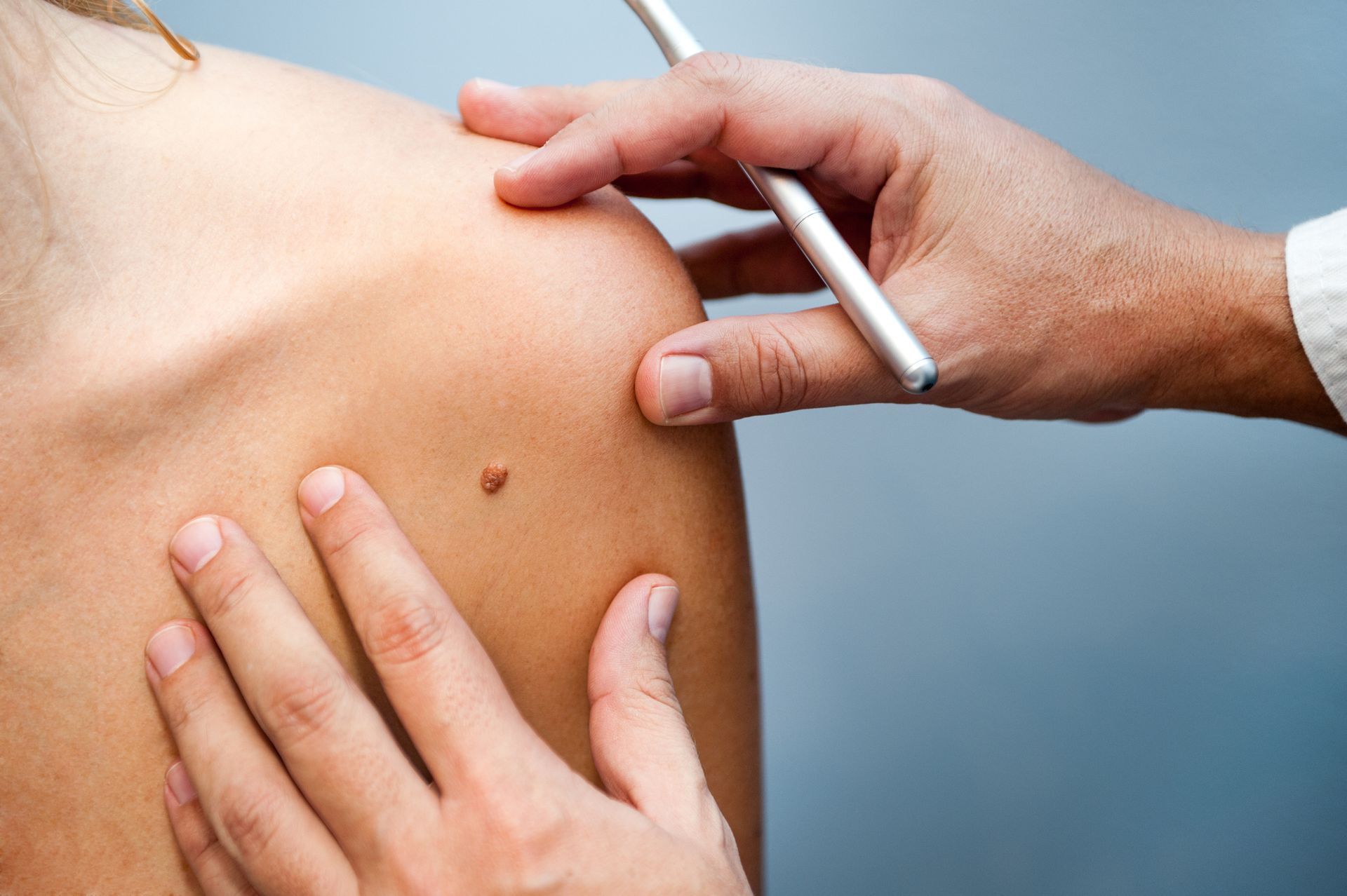 Surgical Dermatology — Urbandale, IA — Greater Des Moines Dermatology