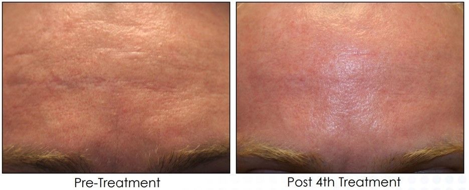 Two pictures of a person 's face before and after a treatment.