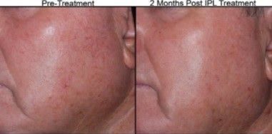 A before and after photo of a woman 's face