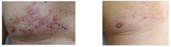 A before and after picture of a person 's chest with acne.