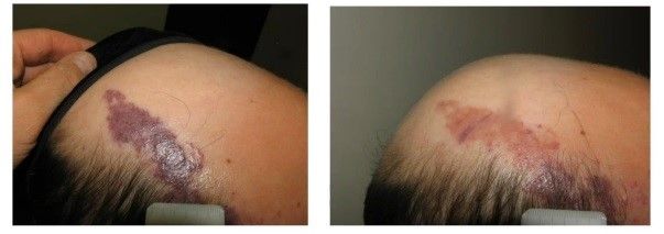 A before and after picture of a person 's head