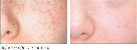 A before and after photo of a person 's face