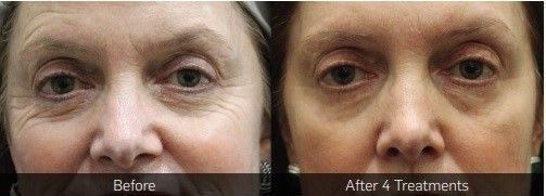 A before and after photo of a woman 's face