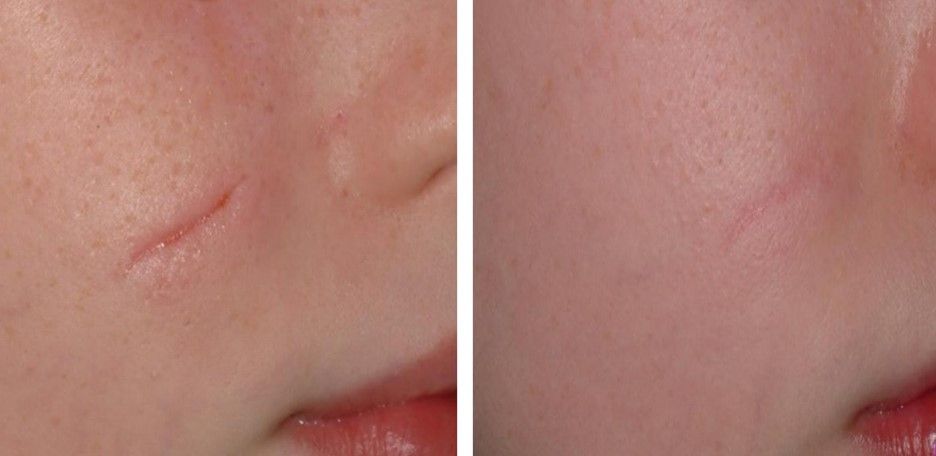 Comparison of skin texture. Before and after view of a scar.