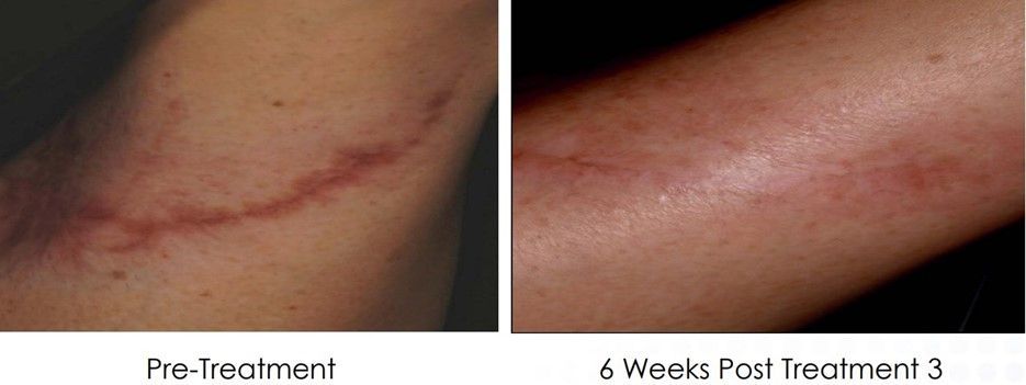 Comparison of a scar on an arm before treatment and six weeks after three treatments, with the scar appearing lighter and less prominent.