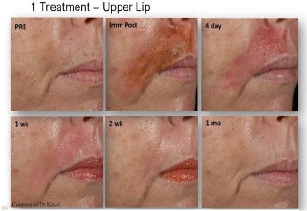 A picture of a woman 's face with the caption 1 treatment upper lip
