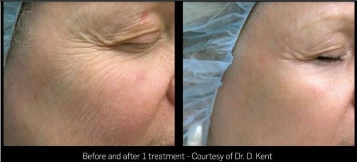 A before and after photo of a person 's face