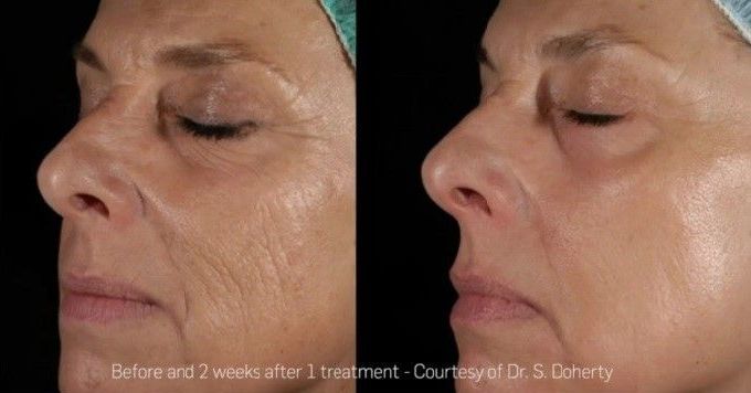 A before and after photo of a woman 's face