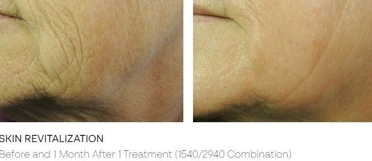 Before and after comparison of skin revitalization treatment, showing smoother skin.
