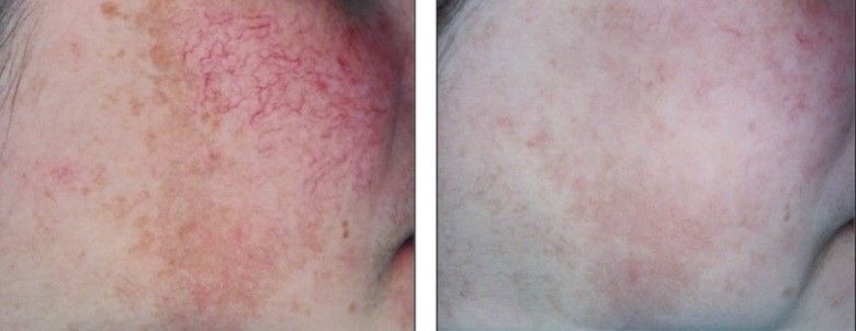 A before and after photo of a person 's face with red spots.