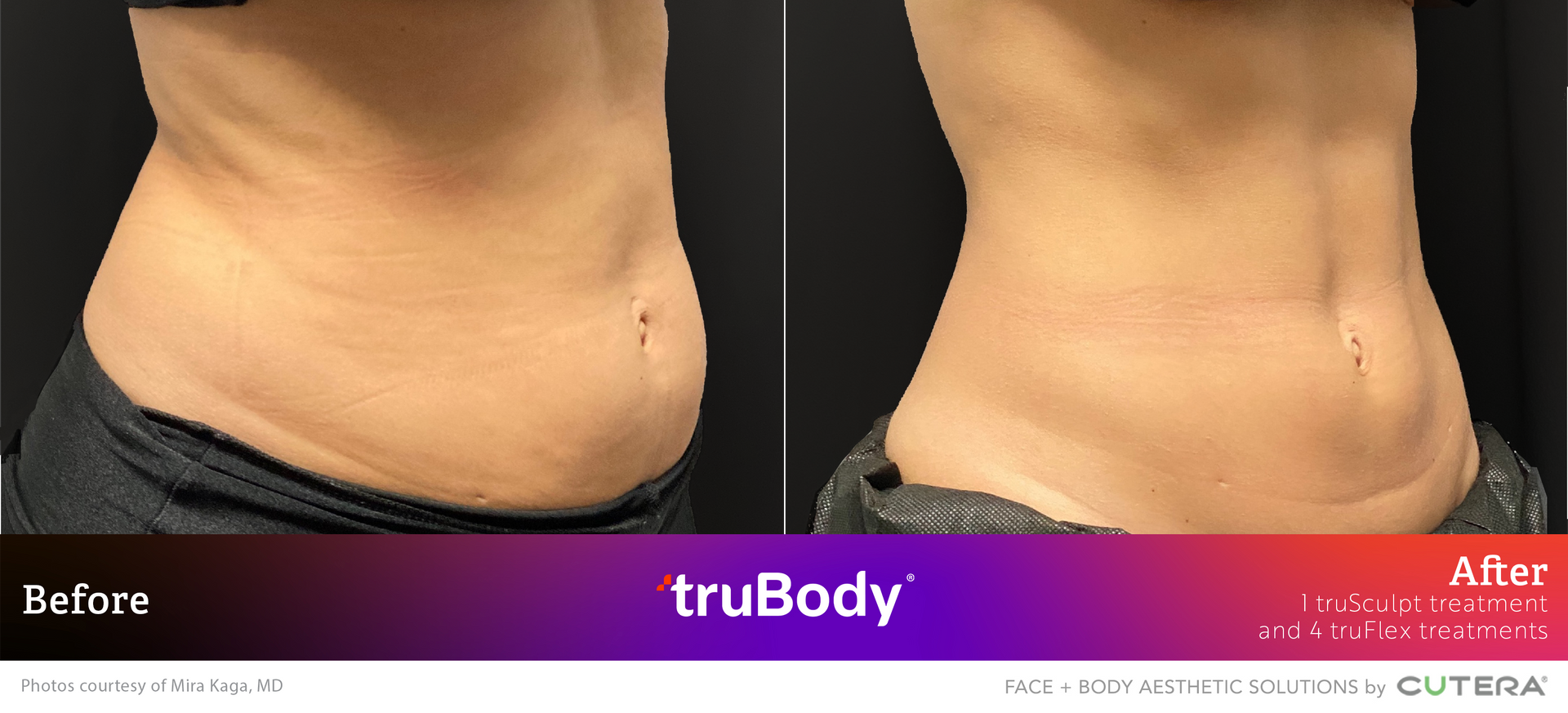 A before and after photo of a woman 's stomach.