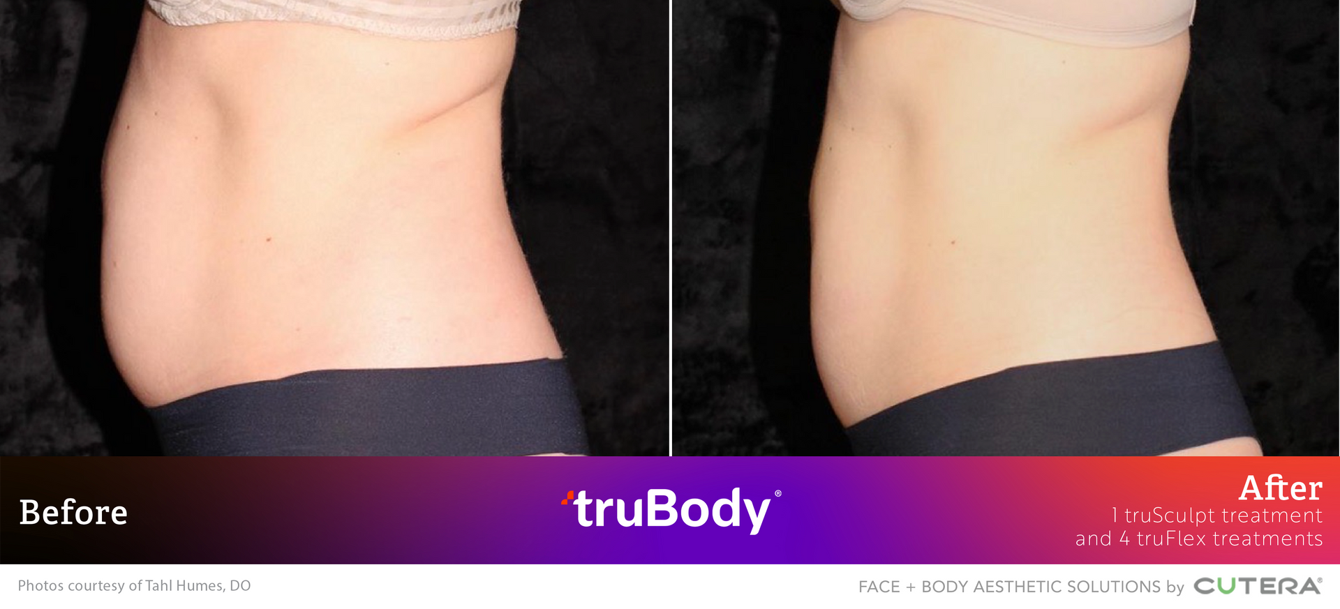 A before and after photo of a woman 's stomach.