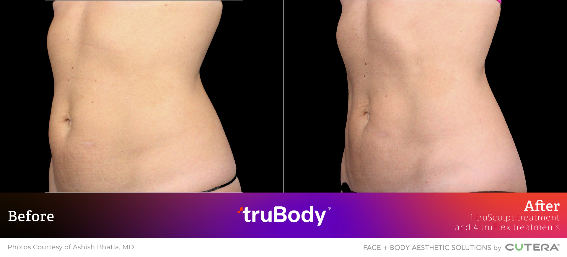 Side-by-side comparison of a person's abdomen before and after truBody procedure, showing body contouring.