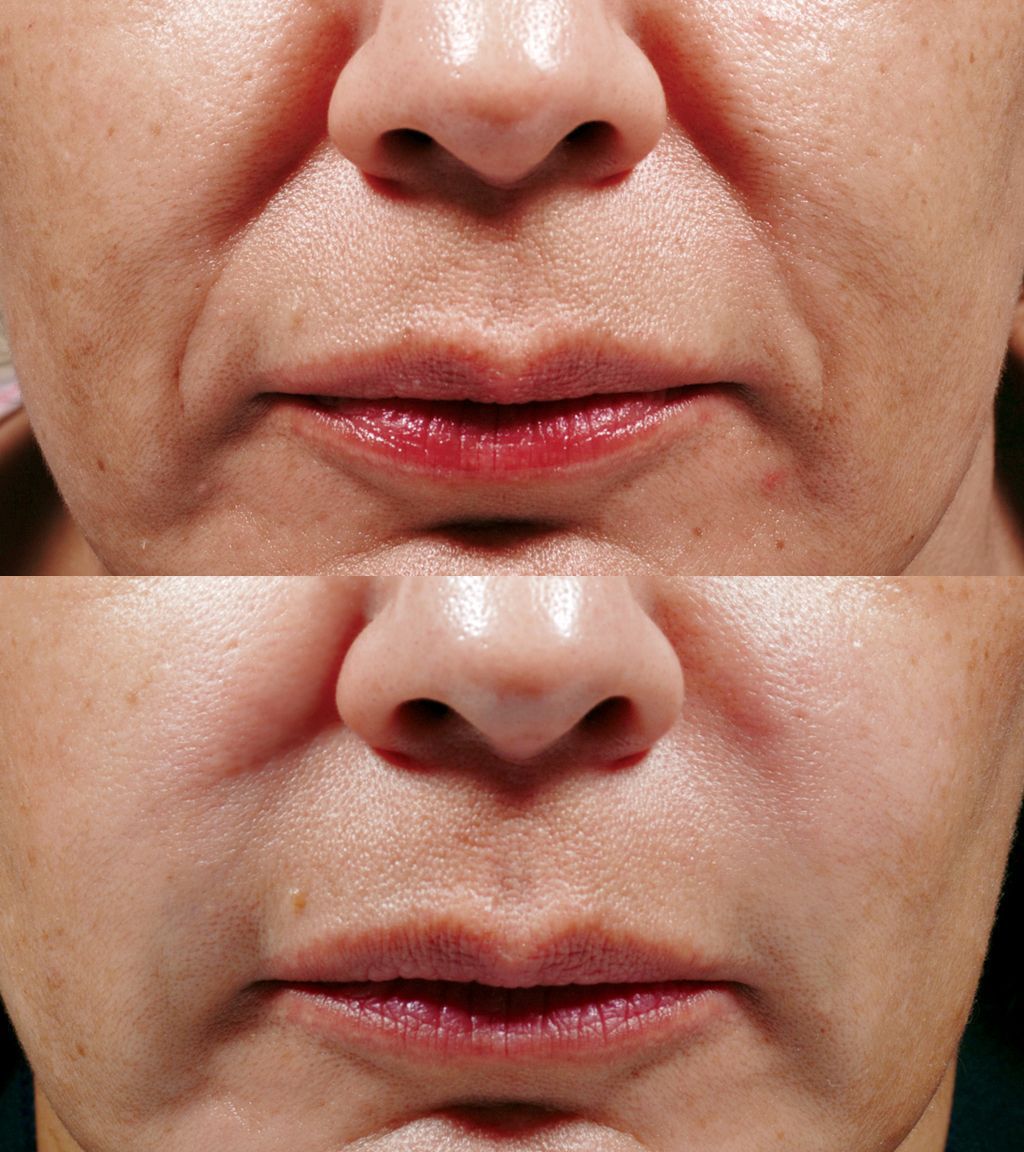 A before and after photo of a woman 's face