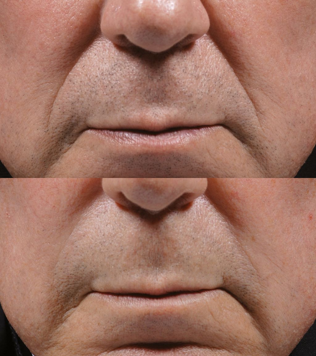 A before and after photo of a man 's face with wrinkles.
