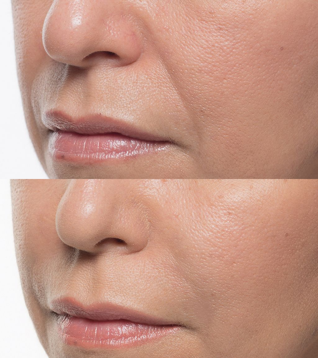 A before and after photo of a woman 's face with wrinkles.