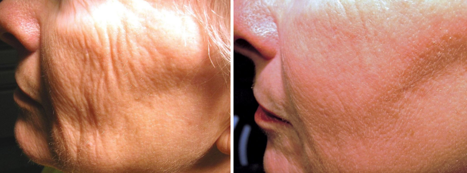 A before and after photo of a woman 's face with wrinkles.