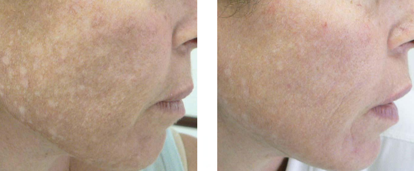 A before and after photo of a woman 's face.