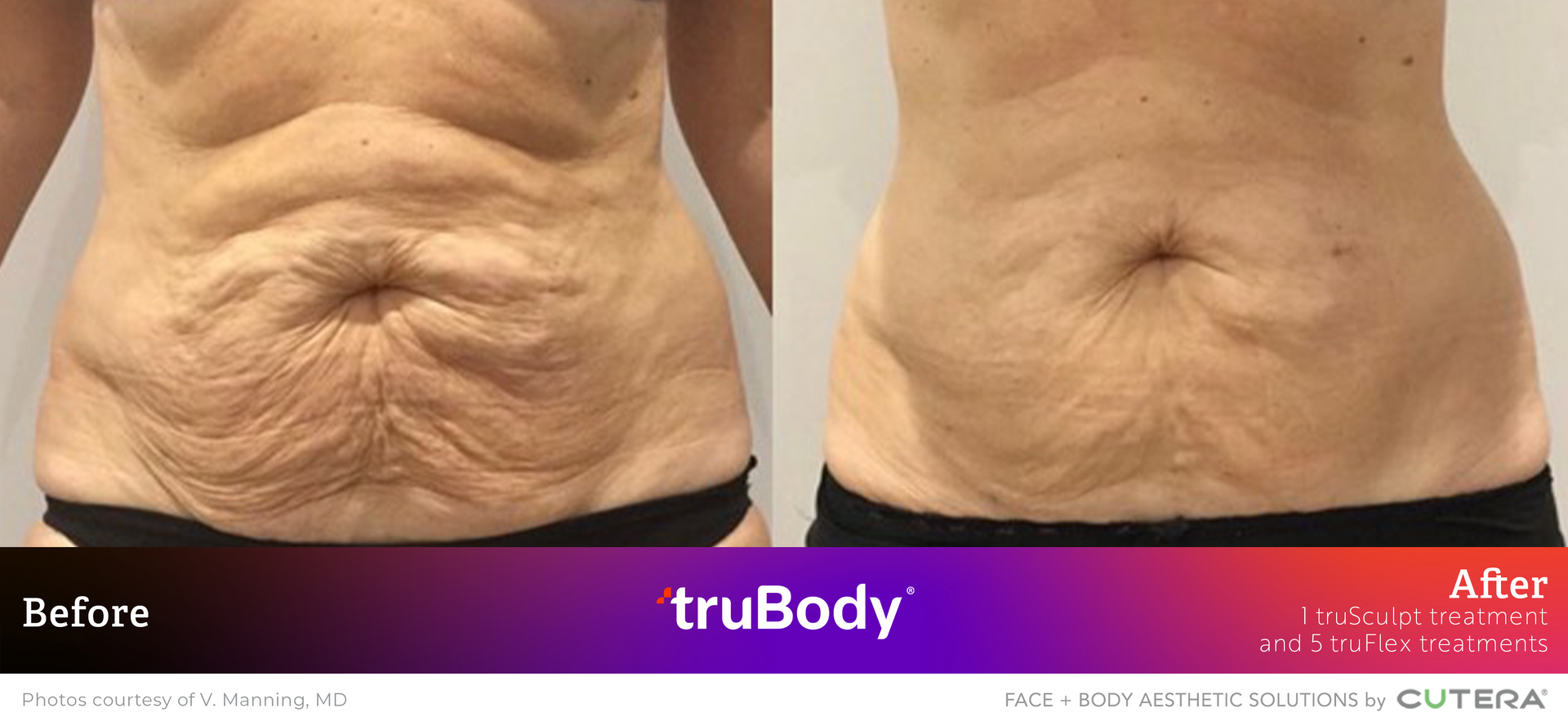 A before and after picture of a woman 's stomach.