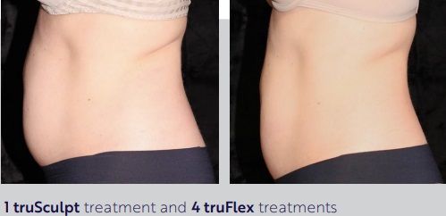 A before and after photo of a woman 's stomach.