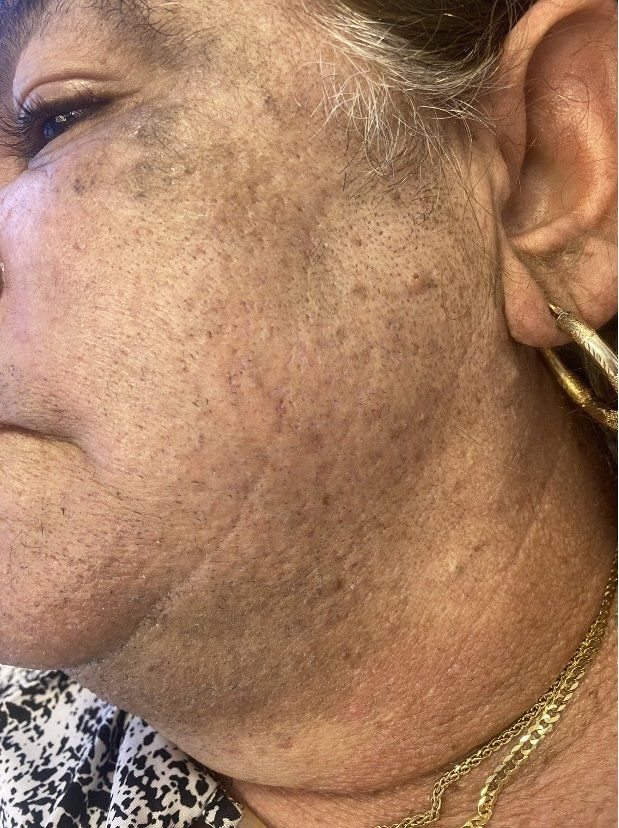 Primer plano del rostro y el cuello de una mujer mayor. La piel muestra manchas de la edad, arrugas y poros visibles.