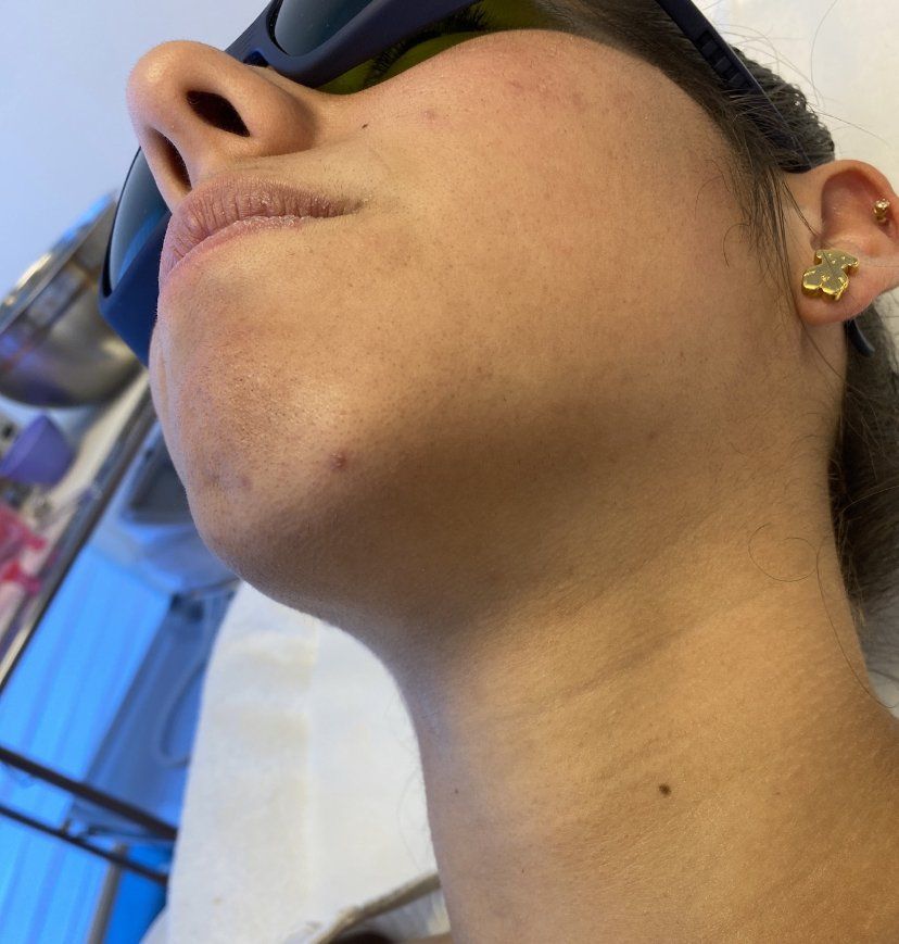 Mujer que usa gafas protectoras y tiene la barbilla inclinada hacia arriba, examinando la piel para tratamiento con láser.