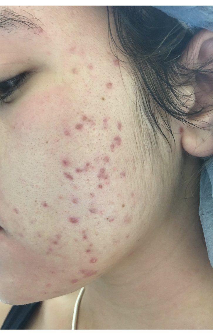 Una persona con acné visible en las mejillas y la mandíbula. La piel se ve rojiza y presenta pequeñas protuberancias.