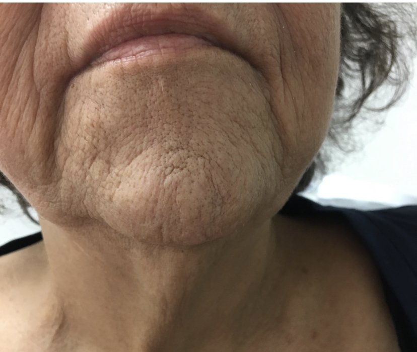 Primer plano del cuello y el mentón de una persona que muestra arrugas y piel envejecida.