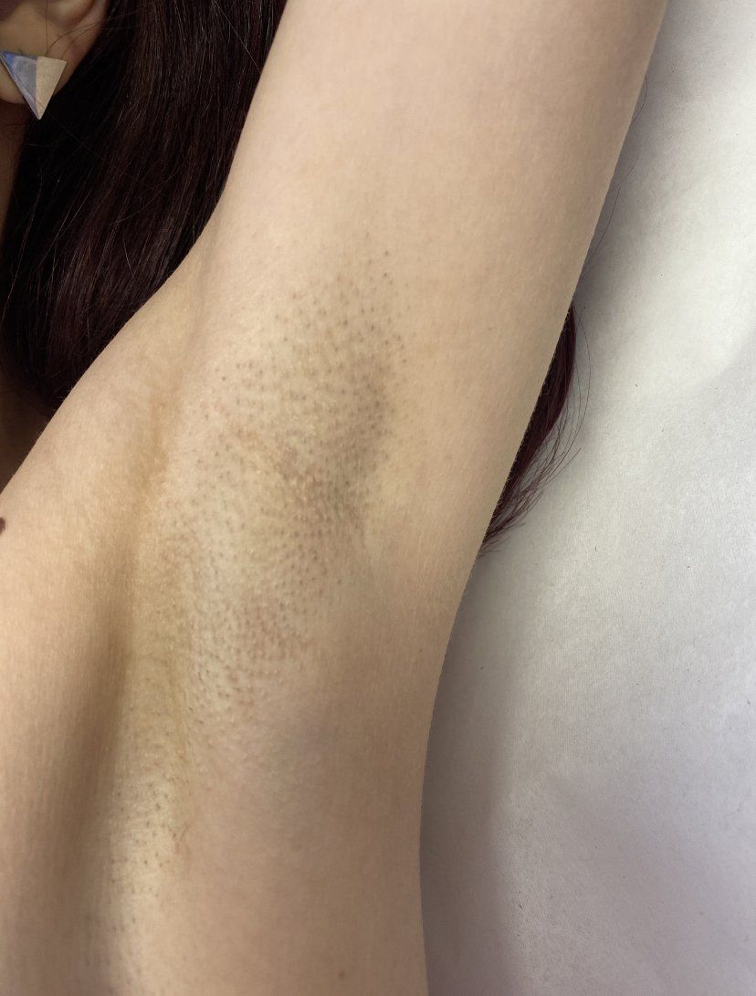 Axila de una persona con cabello oscuro, vista de espaldas. La piel es clara con algunas sombras.