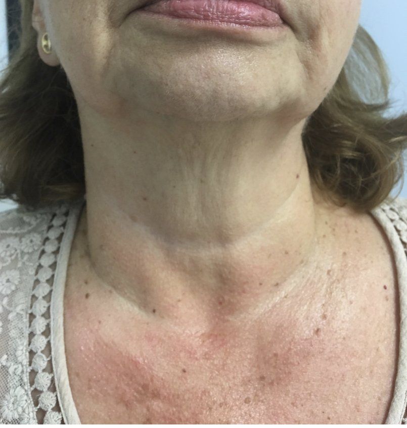 Cuello y escote de una mujer mayor, piel con arrugas y manchas solares.