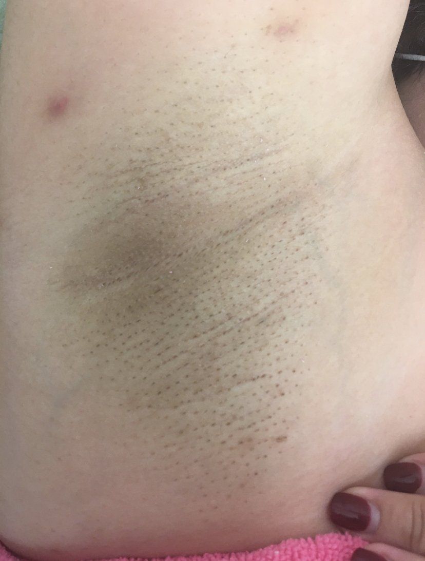 Axila con piel oscura y descolorida; posibles pelos encarnados o irritación.