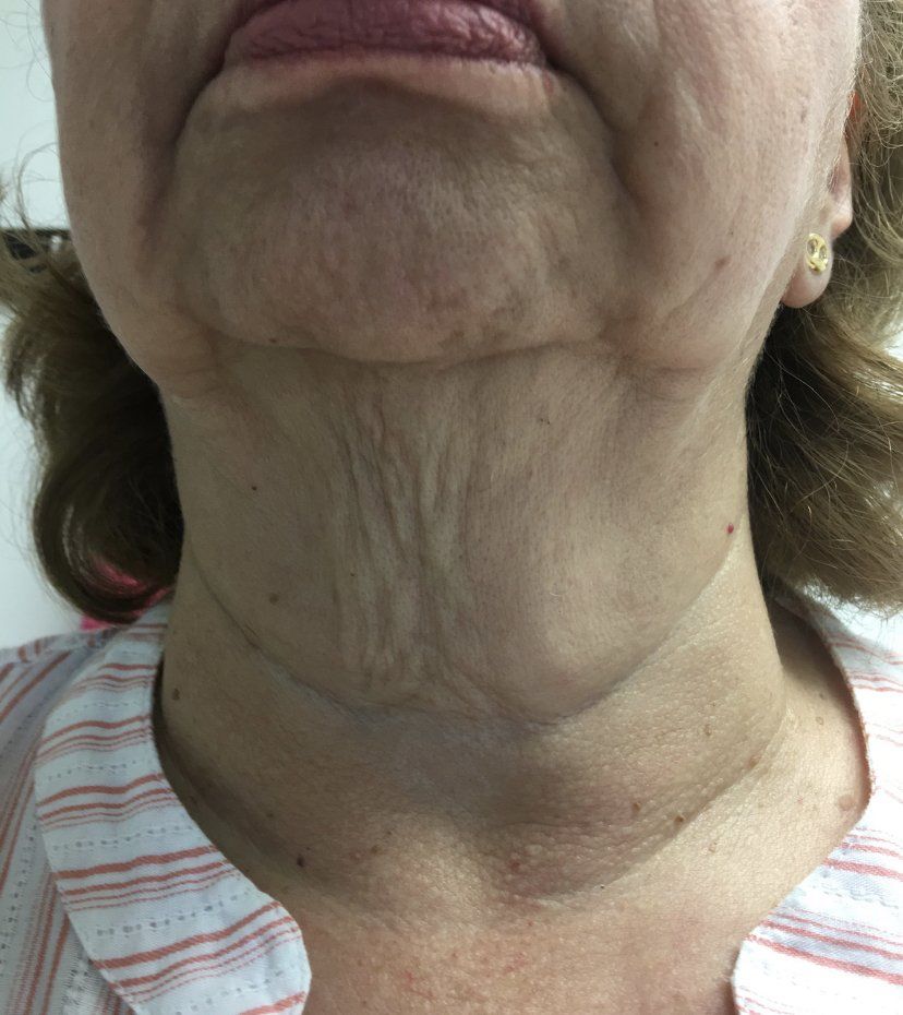Primer plano del cuello y la parte inferior de la cara de una persona mayor, mostrando piel flácida, arrugas y papada.