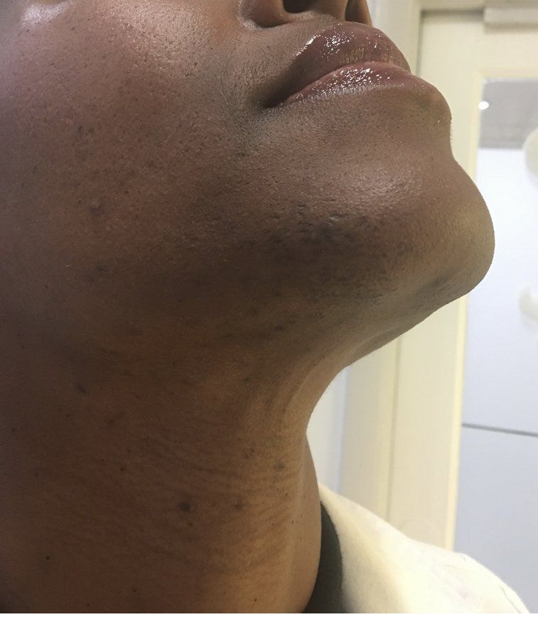 Se ven el mentón, el cuello y el labio inferior. La piel es oscura, con algunos pelos oscuros en el mentón.