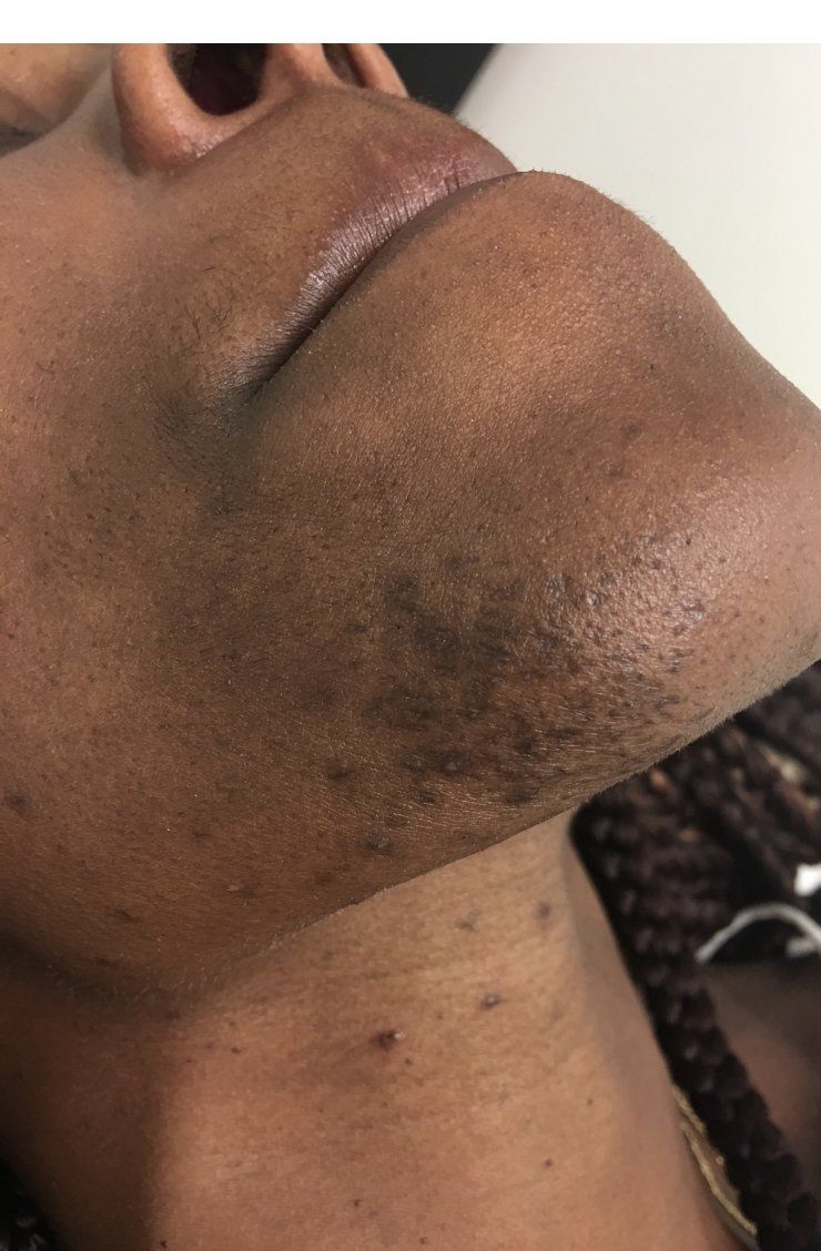 Primer plano del mentón y el cuello de una persona con crecimiento de cabello oscuro e imperfecciones en la piel.