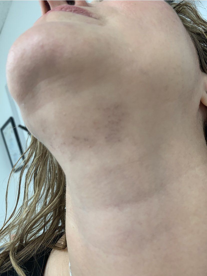 Primer plano del cuello y la barbilla de una persona. Se observan hematomas en la mandíbula inferior y el cuello.