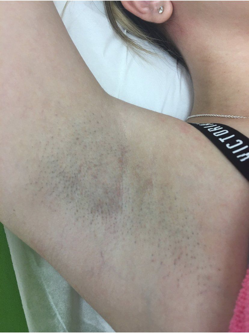 Axila con pelo oscuro, piel ligeramente descolorida; brazo de mujer levantado.