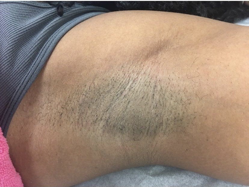 Axila con pelo oscuro, ropa gris visible y pliegues en la piel.