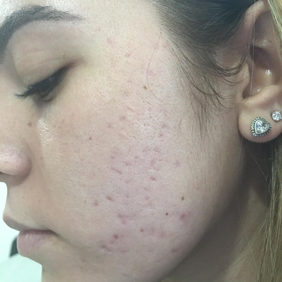 Mujer con cicatrices de acné en la mejilla. Piel clara, perfil en primer plano.