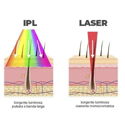 Confronto tra epilazione IPL e laser: la IPL utilizza un ampio spettro luminoso, il laser utilizza una luce focalizzata.