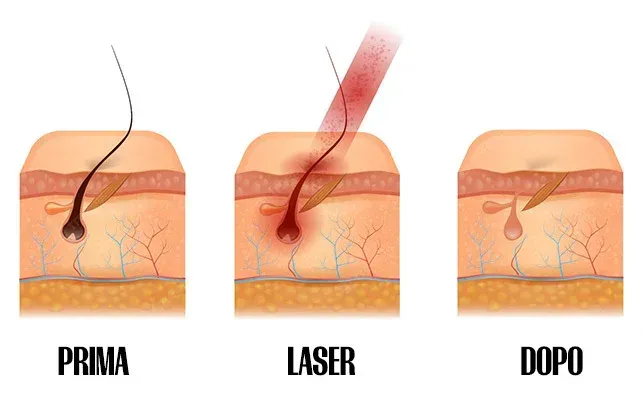 Diagramma: Processo di epilazione laser. La sezione trasversale della pelle mostra il follicolo pilifero prima, durante e dopo il trattamento laser.